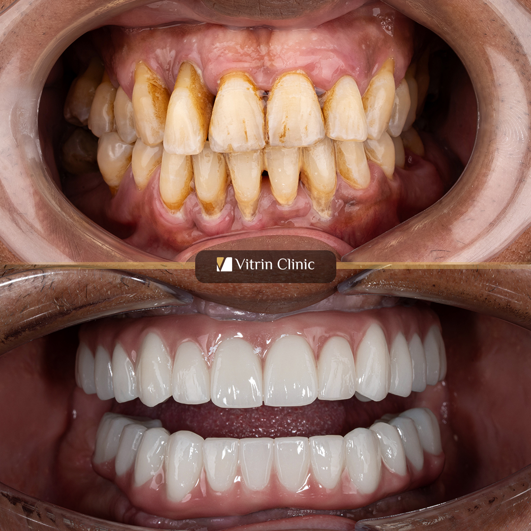 Javan dental implants